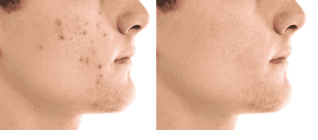 Before and after anti-aging skin results showing smoother skin, reduced fine lines, and improved firmness linked to hibiscus tea benefits.