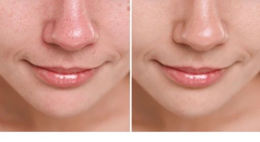 Before and after comparison of facial skin showing deep cleansing effects, reduced impurities, and refreshed skin appearance.