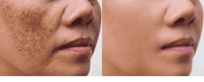 Before and after skin comparison showing reduced hyperpigmentation and dark spots with more even skin tone.