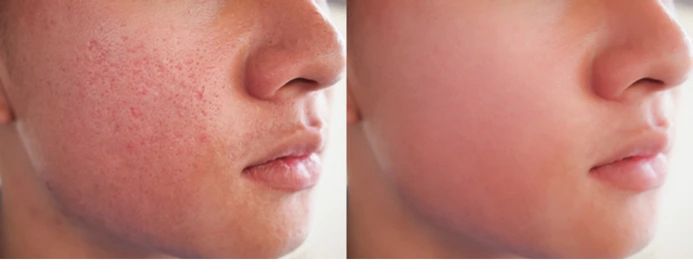 Before and after comparison showing reduced open pores and smoother skin