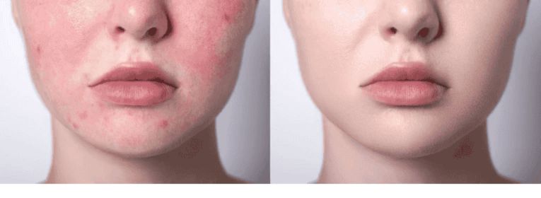Before and after facial skin image showing reduced redness, calmer skin, and improved skin barrier health.