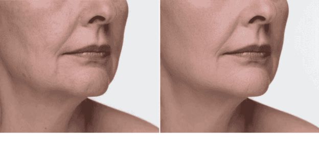 Before and after image highlighting improved skin elasticity and firmness with visibly tighter and youthful skin.