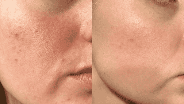 Before and after skin comparison showing soothed skin with reduced irritation, inflammation, and enhanced comfort.