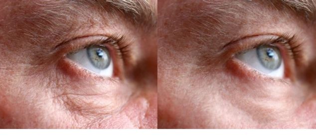 Before and after under-eye puffiness showing smoother skin around the eyes.